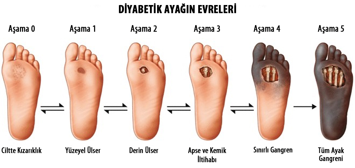 Diyabetik Ayak Bakm